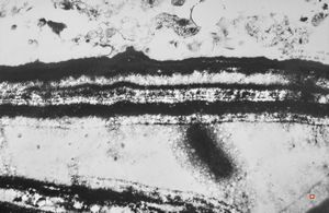M,66y. | follicular cyst with hyaline Rushton bodies M,66y. | follicular cyst with hyaline Rushton bodies